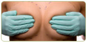 Breast Lifts